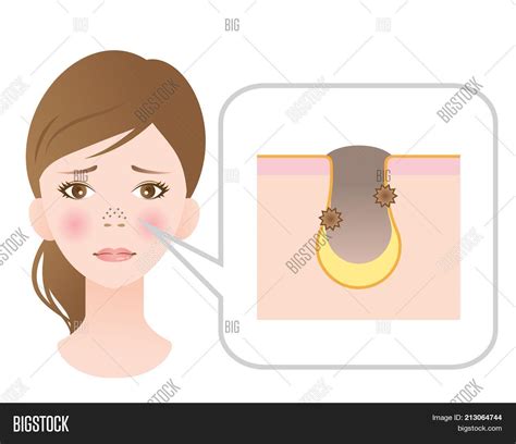 Clogged Pores On Nose Image & Photo (Free Trial) | Bigstock