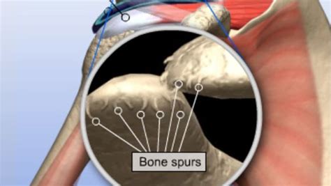 Distal Clavicle Resection – UnderstandOrtho™