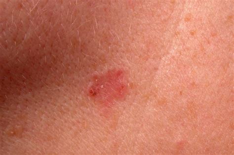 Basal Cell Carcinoma Pictures | Getty Images