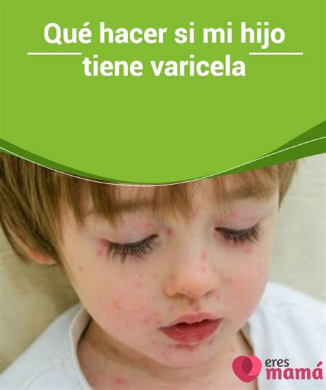 Que hacer si mi hijo tiene varicela Cómo puedo saber si mi hijo tiene