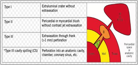 Coronary Artery Perforations Glasgow Natural History Study Of Covered