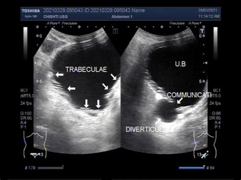 Bladder Diverticulum Ultrasound