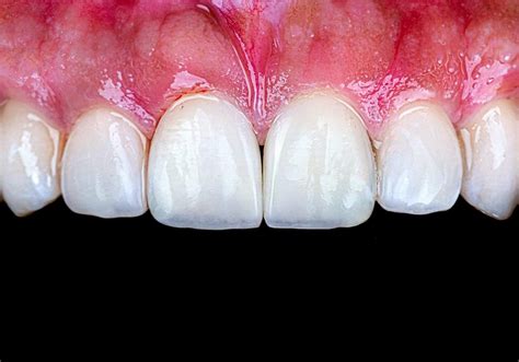 Diastema Closure A Step By Step Protocol MyZerodonto