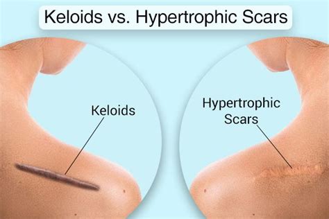 Hypertrophic Scar Vs Keloid