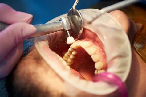 La Importancia De La Limpieza Dental Profesional Consultorio