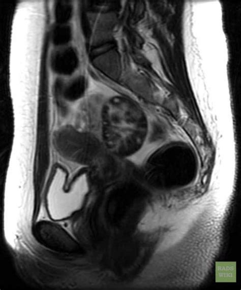 Ovarian Torsion Mri Wikidoc