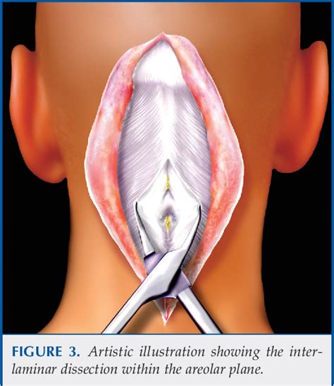 Figure 3 From Anatomy Of The Nuchal Ligament And Its Surgical Applications Semantic Scholar