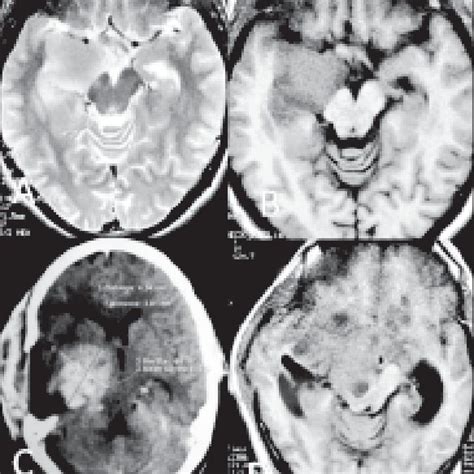 A Preoperative MRI Of Brain A T2 Weighted Axial Image And B T1W Axial