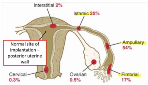 Ectopic Pregnancy Flashcards Quizlet