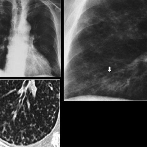 Pneumocystis Carinii Pneumonia Atypical Features Chest X Ray Shows Download Scientific Diagram