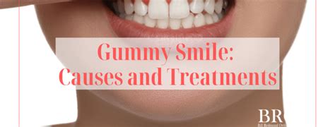 Gummy Smile Causes And Treatments Can It Be Fixed