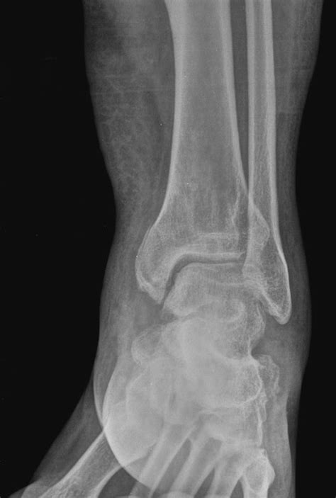 Malleolus Fracture / Operative Treatment Of Posterior Malleolar ...