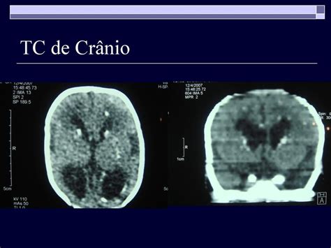 Caso Cl Nico Parvovirose Internato Em Pediatria Escs Hras Ppt