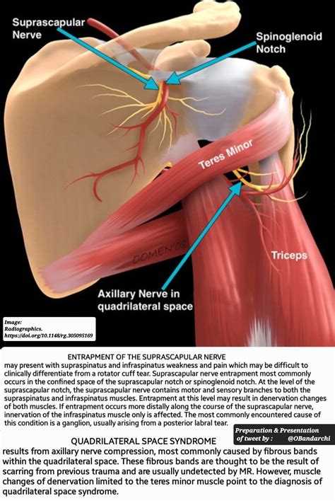 Dorsal Scapular Nerve Entrapment