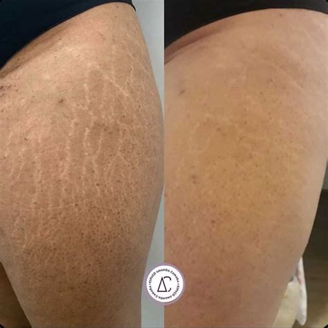 Camuflagem De Estrias Como é Feito E O Antes E Depois