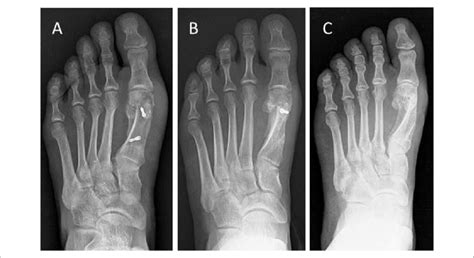 Postoperative Dorsoplantar Weightbearing Radiographs Of 3 Techniques