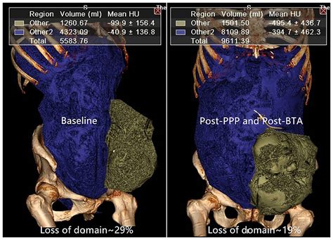 Frontiers Preoperative Progressive Pneumoperitoneum And Botulinum