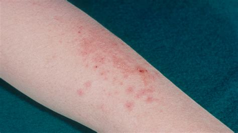 Rare Sexually Transmitted Ringworm Reported In Nyc