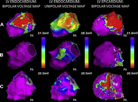 E Representative Dimensional Electroanatomic Maps From Three Patients