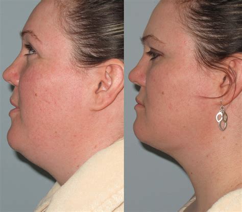 Skinny Lipo Of Neck Of Chin With Laser