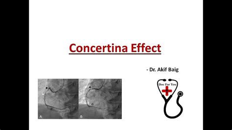 Concertina Effect Dr Akif Baig YouTube