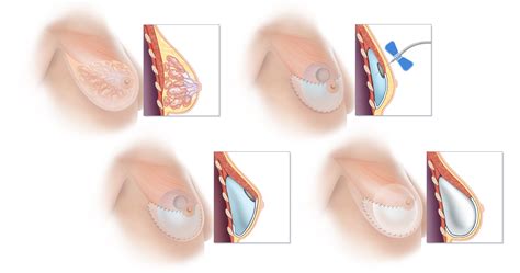 Breast Reconstruction Options Tprsg