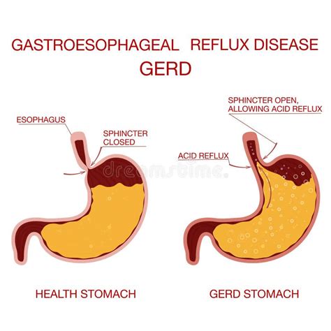 Heartburn And Gastroesophageal Reflux Disease Gerd Concept Health Stock