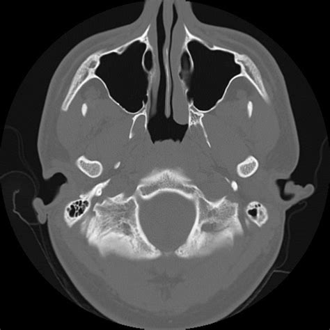 Normal Temporal Bone Ct With Annotated Images Radiopaedia