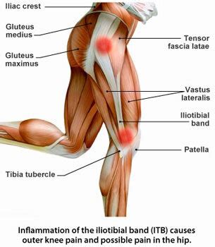 Lateral Knee Pain, ITB Friction Syndrome — Limitless Bronte