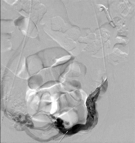 Gonadal Vein Transposition In Nutcracker Syndrome Annals Of Vascular