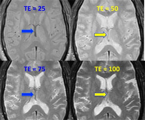 Even Echo Rephasing Questions And Answers In MRI