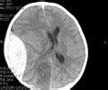 Epidural Hematoma Flashcards Quizlet