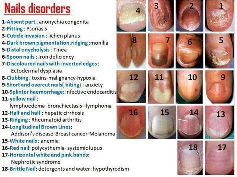 Top 10 nail disorders ideas and inspiration