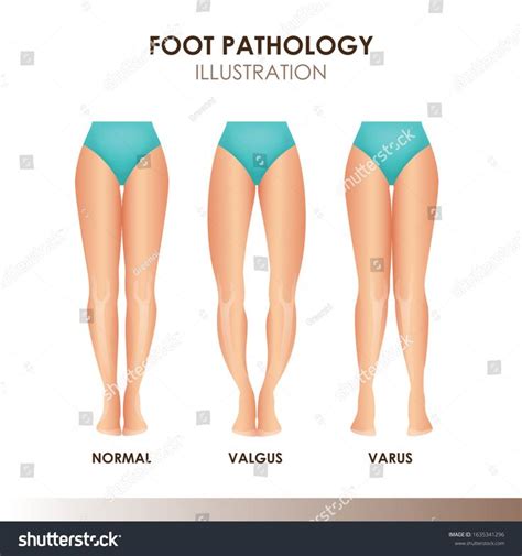 Foot Pathology Illustration Normal Valgus Varus Stock Vector Royalty