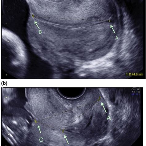 Measurement Of Cervical Length When Isthmus Is Absent A Or Present