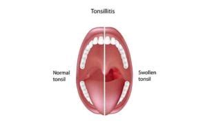 Tonsillitis-Diagram - Los Angeles ENT Doctor