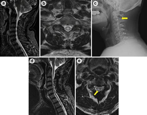 A Sagittal Magnetic Resonance Image T2 Weighted Imaging T2wi Fat