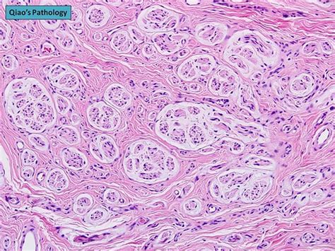 Qiaos Pathology Traumatic Neuroma Microscopic Photo Show Flickr