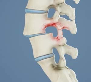 Spondylolisthesis Arlington, TX | Back Pain Treatment Irving & Frisco, TX