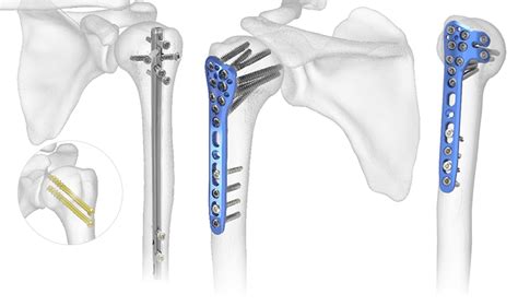 Proximal Humerus Fractures Acumed Information