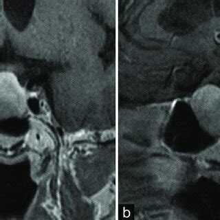 (a) Magnetic resonance imaging (MRI) coronal section preoperative brain ...