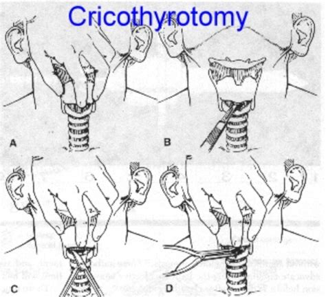 Surgery Exam Flashcards Quizlet