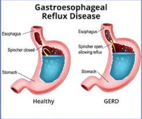 Gastroesophageal Reflux Disease Gerd Symptoms Causes And Treatment