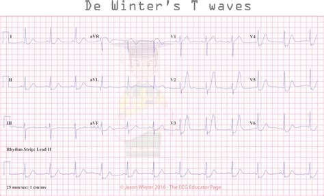 ECG Educator Blog : De Winters T waves