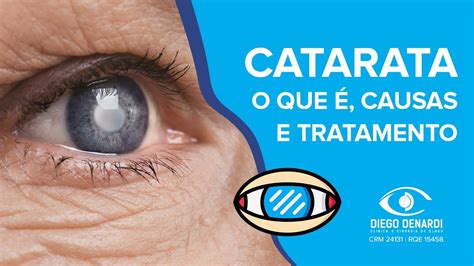 Catarata O Que Causas E Tratamento Youtube