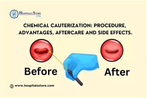 Chemical Cauterization: Procedure, Advantages, Aftercare and Side Effects.