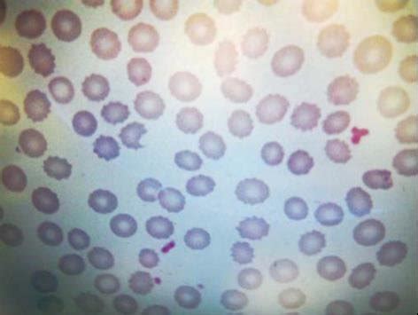 Acanthocytes observed in the peripheral blood smear of the patient ...