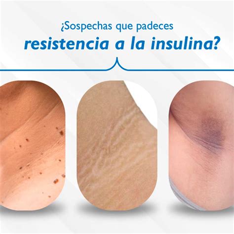 Resistencia A La Insulina Mi Glucosa