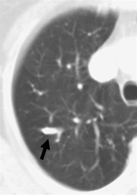 Mucus Plugging Axial CT Lung Window Shows Calcified Linear Bronchial