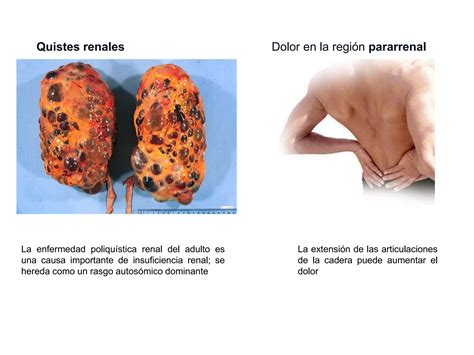 Riñones Uréteres y Glándulas Suprarrenales PPT